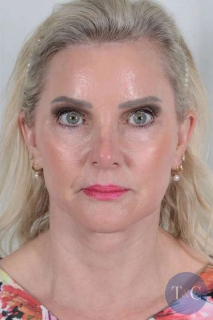 Facelift Before & After Patient #1038