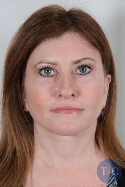 Facelift Before & After Patient #1043