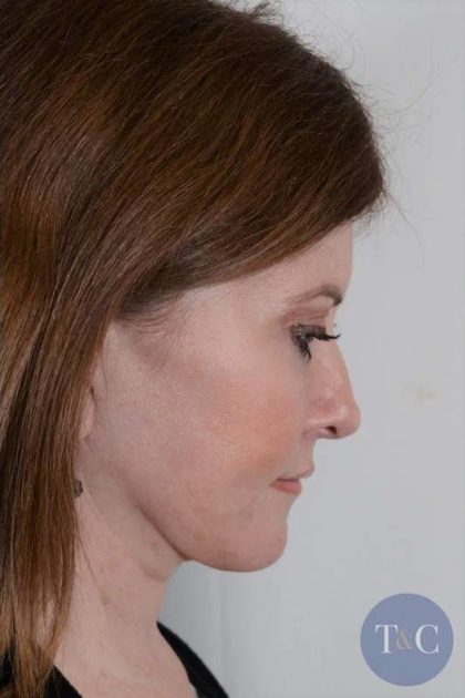Neck Lift Before & After Patient #1075