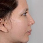 Neck Lift Before & After Patient #1085