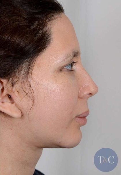 Neck Lift Before & After Patient #1085