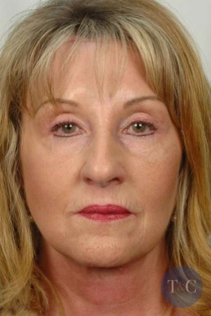 Neck Lift Before & After Patient #1115