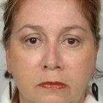 Neck Lift Before & After Patient #1135
