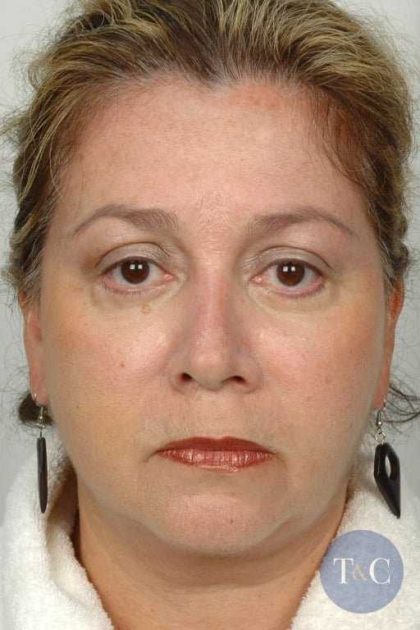 Neck Lift Before & After Patient #1135
