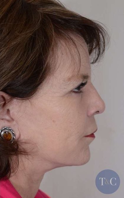 Neck Lift Before & After Patient #1145