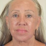 Neck Lift Before & After Patient #1150