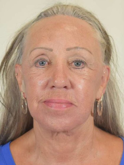Neck Lift Before & After Patient #1150