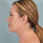Neck Lift Before & After Patient #1157