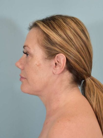 Neck Lift Before & After Patient #1157