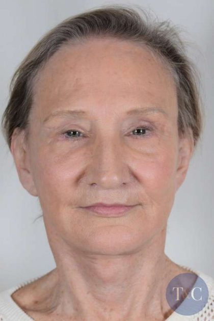 Facial Fat Transfer & Grafting Before & After Patient #1220