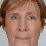 Facial Fat Transfer & Grafting Before & After Patient #1225
