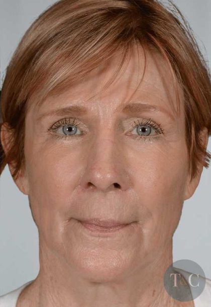 Facial Fat Transfer & Grafting Before & After Patient #1225