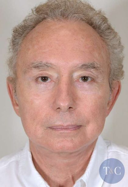 Men's Facelift Before & After Patient #1249