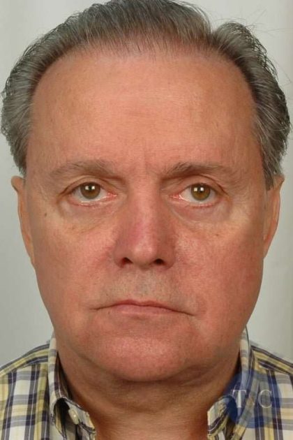Men's Facelift Before & After Patient #1254