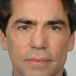 Men's Facelift Before & After Patient #1259
