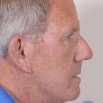Men's Facelift Before & After Patient #1269