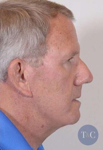 Men's Facelift Before & After Patient #1269