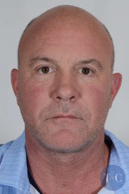 Men's Facelift Before & After Patient #1274