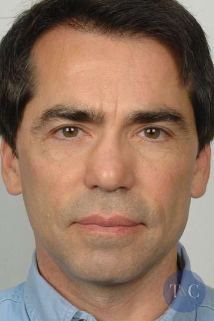Men's Necklift Before & After Patient #1306