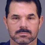 Men's Necklift Before & After Patient #1311