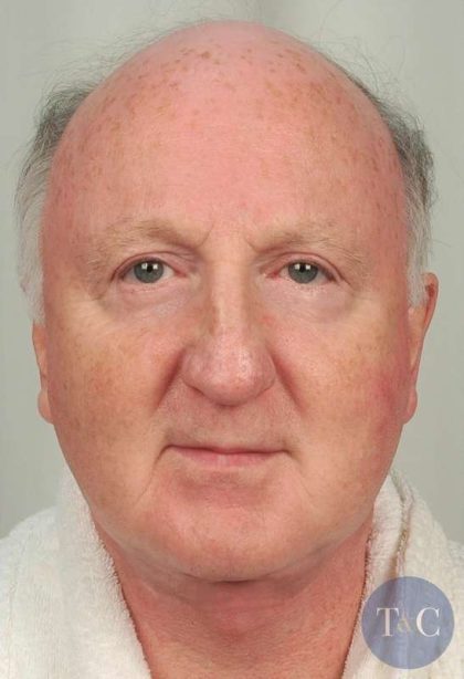 Men's Necklift Before & After Patient #1326