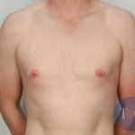 Gynecomastia Before & After Patient #1354