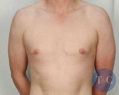Gynecomastia Before & After Patient #1354