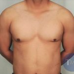 Gynecomastia Before & After Patient #1359