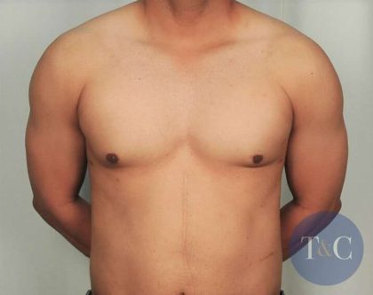 Gynecomastia Before & After Patient #1359