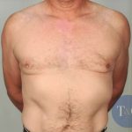 Gynecomastia Before & After Patient #1364