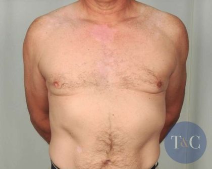 Gynecomastia Before & After Patient #1364