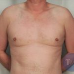 Gynecomastia Before & After Patient #1369