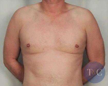 Gynecomastia Before & After Patient #1369