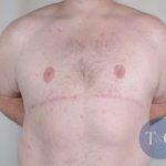 Gynecomastia Before & After Patient #1374
