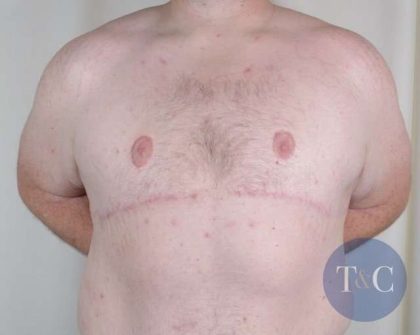 Gynecomastia Before & After Patient #1374