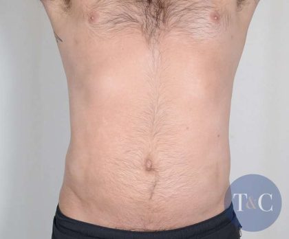 Men's Liposuction Before & After Patient #1379