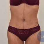 Tummy Tuck Before & After Patient #206