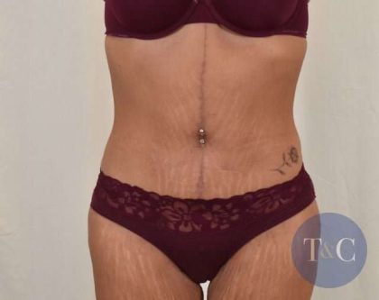 Tummy Tuck Before & After Patient #206