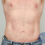Men's Liposuction Before & After Patient #1384
