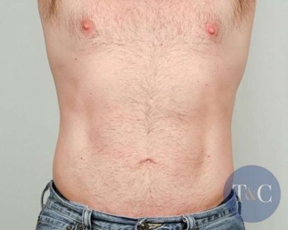 Men's Liposuction Before & After Patient #1384