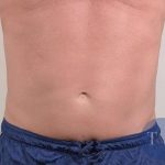 Men's Liposuction Before & After Patient #1389