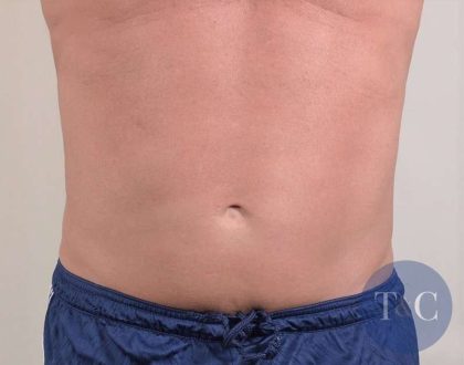 Men's Liposuction Before & After Patient #1389