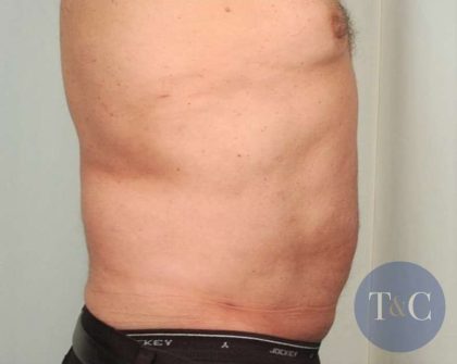 Men's Liposuction Before & After Patient #1396