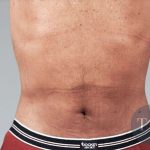 Men's Liposuction Before & After Patient #1401