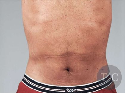 Men's Liposuction Before & After Patient #1401