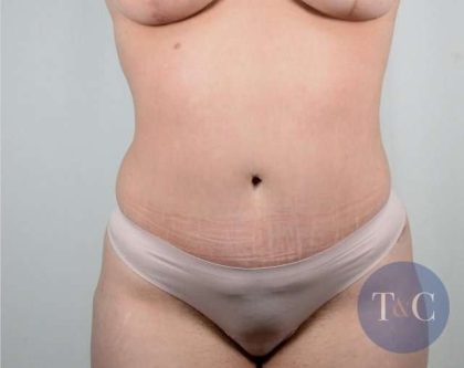 Tummy Tuck Before & After Patient #226