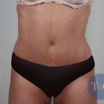 Tummy Tuck Before & After Patient #231