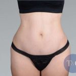 Tummy Tuck Before & After Patient #271