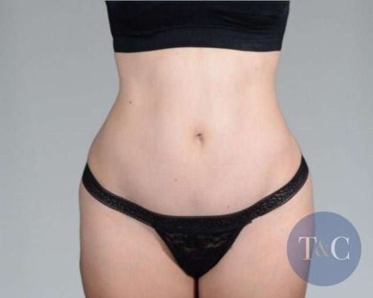 Tummy Tuck Before & After Patient #271