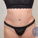 Tummy Tuck Before & After Patient #286